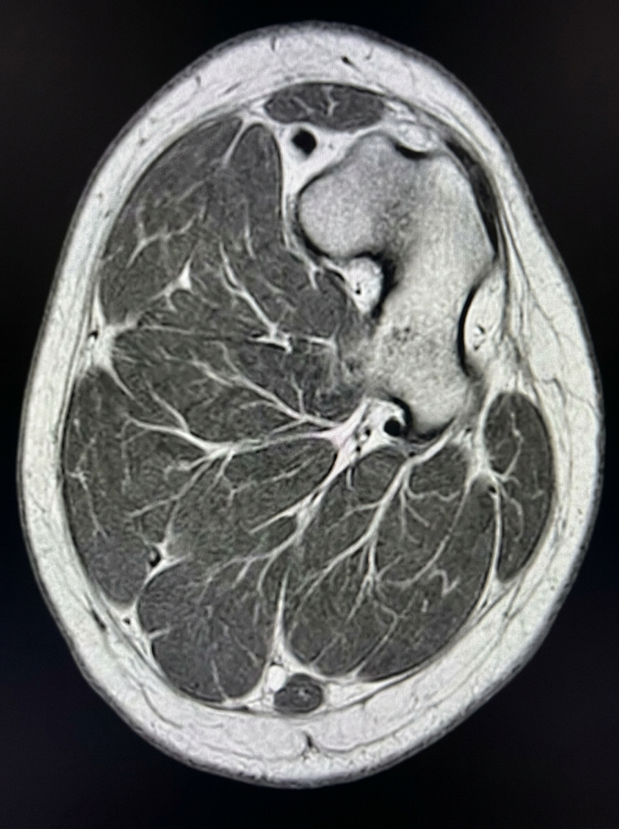 Lucas Smit Facebook ad: Neurologist Goes Rogue: The 'Starving Nerves' Behind Your…