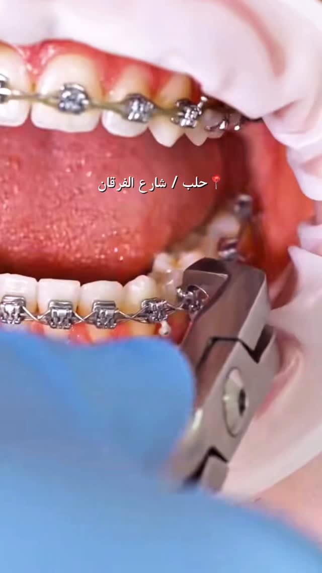 Royal Clinic Aleppo Facebook ad: ابتسامة متناسقة تبدأ مع تقويم الأسنان في رويال…