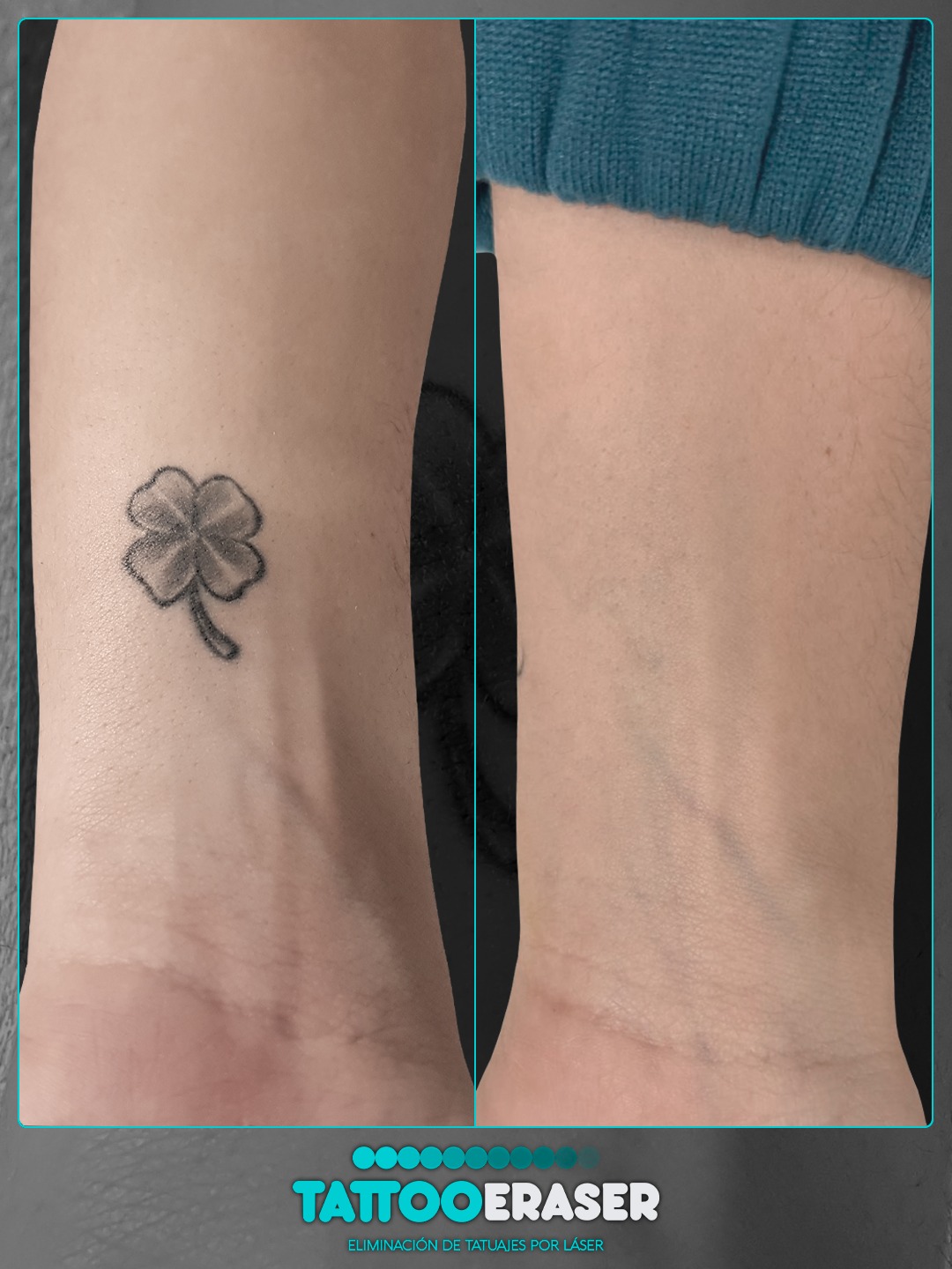 Tattoo Eraser Facebook ad: En esta comparativa mostramos el resultado final tras…