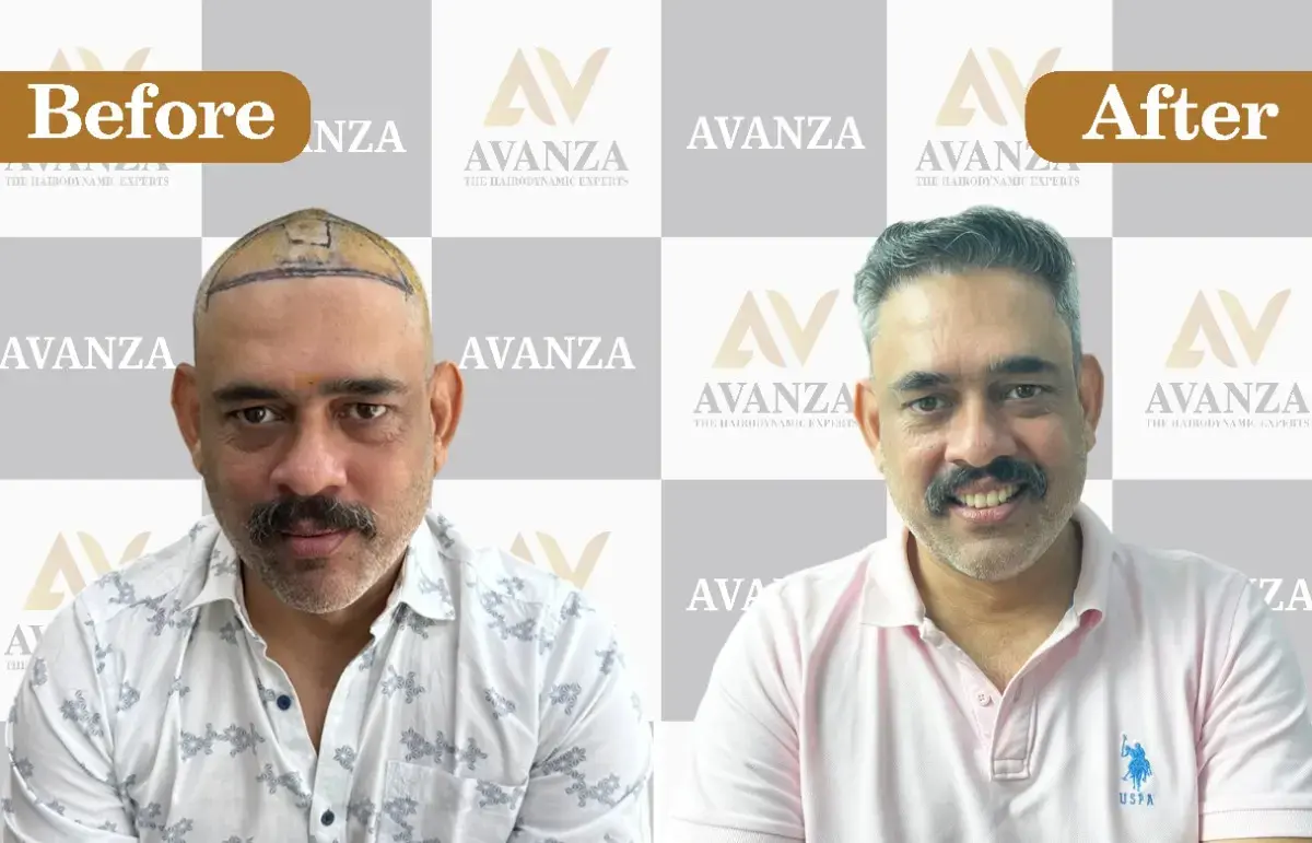 Avanza Clinic Facebook ad from Jun 18, 2026