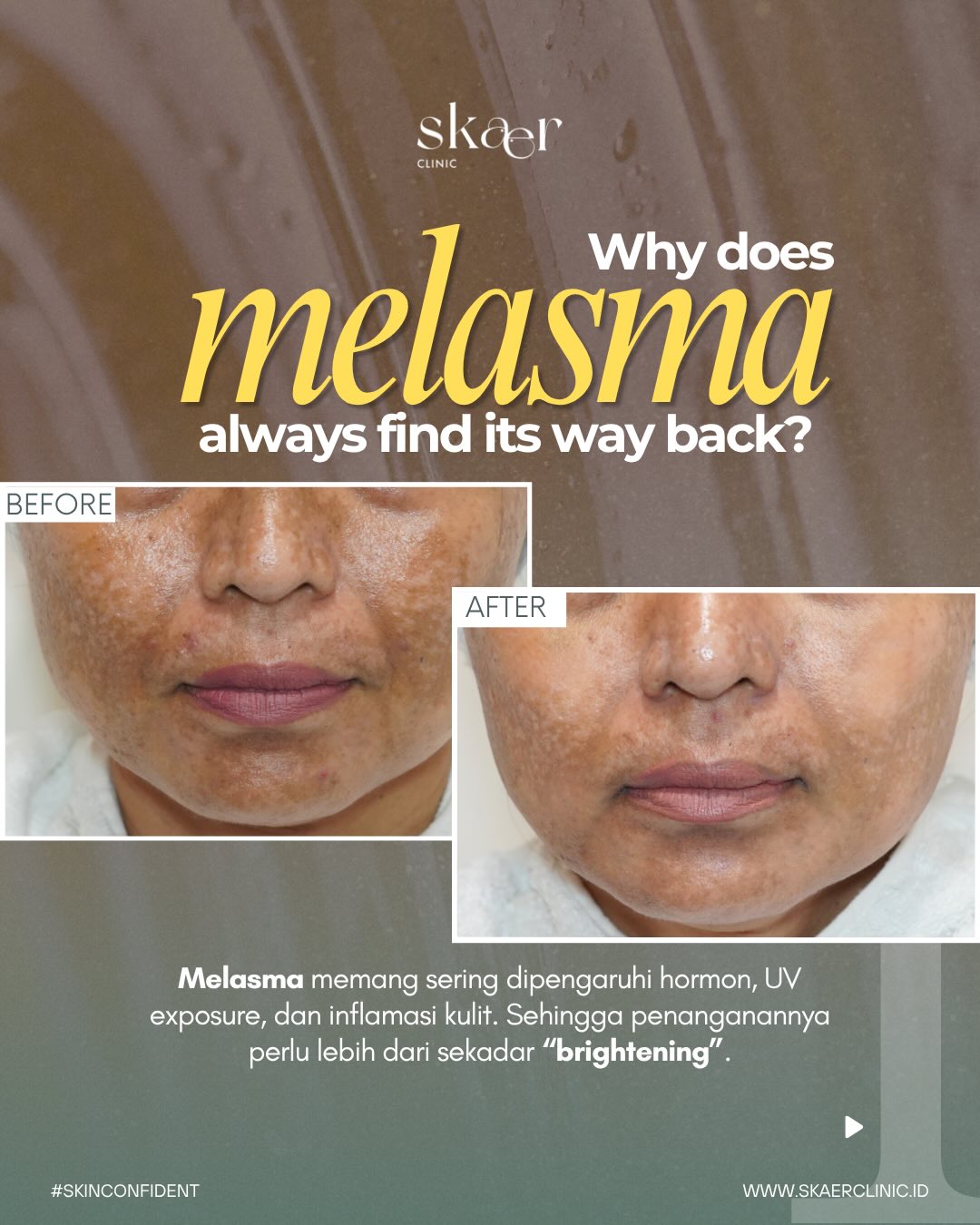 SkaerClinic Facebook ad: Melasma can be so tricky, but let’s not…