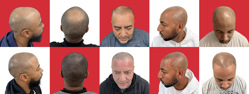 Maxim Scalp Micropigmentation Facebook ad: BYE HAIR LOSS!