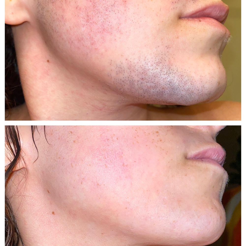 Daily Renewal Facebook ad: Read this if you're plucking your face daily