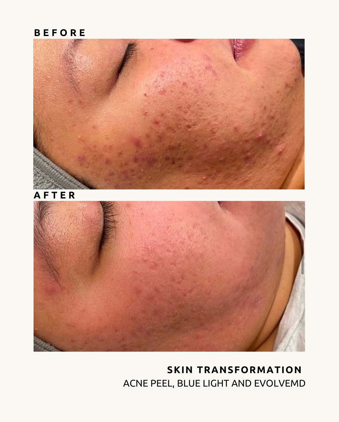 Evolution Laser Clinic Facebook ad: Best Laser Skin Clinic Sydney | Skin Care Clinic |…