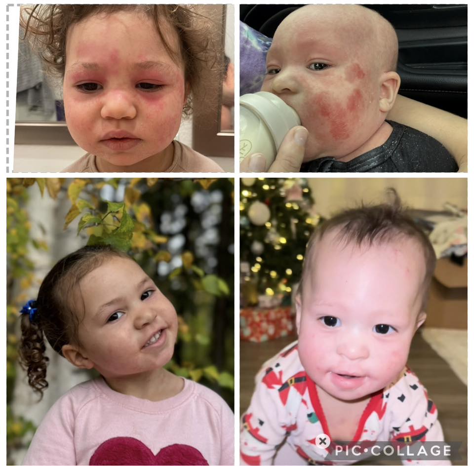 Jessica Rossi Facebook ad: Read this if your baby has eczema