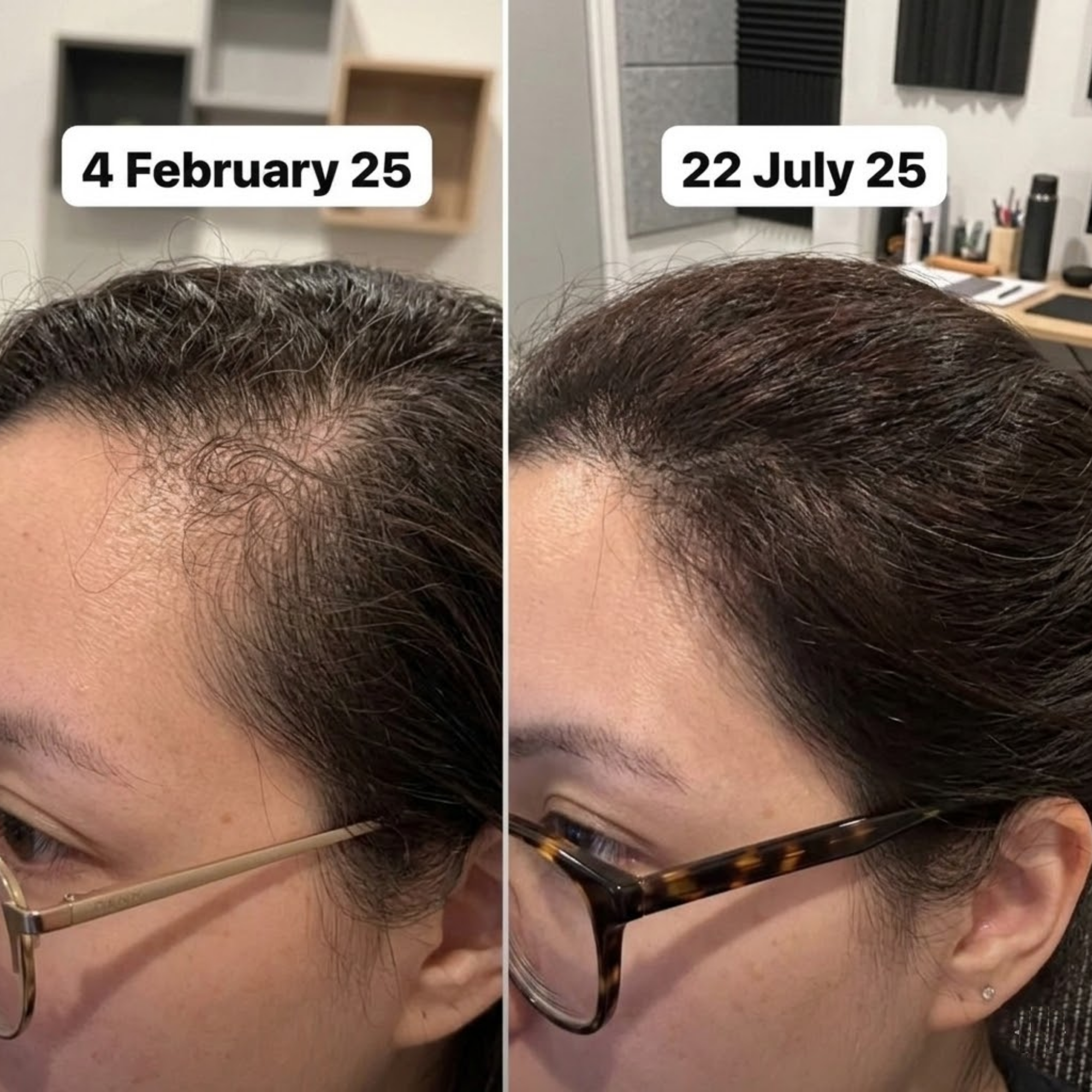 Lisa Thompson Facebook ad: If postpartum hairloss is killing you