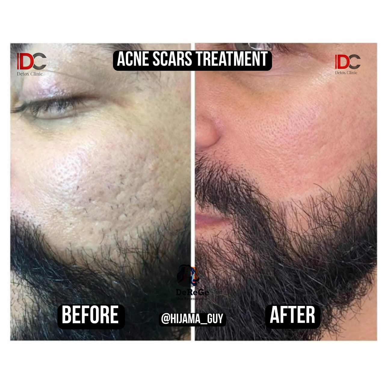 Detox Clinic Facebook ad: Successful Results Of Acne Scars By DeGeRe Treatment