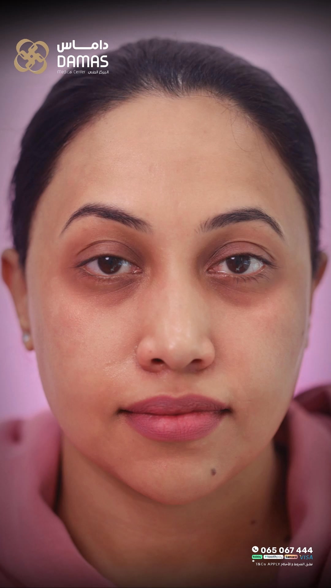 Damas Medical Center Facebook ad: Stop asking your concealer to do the impossible.