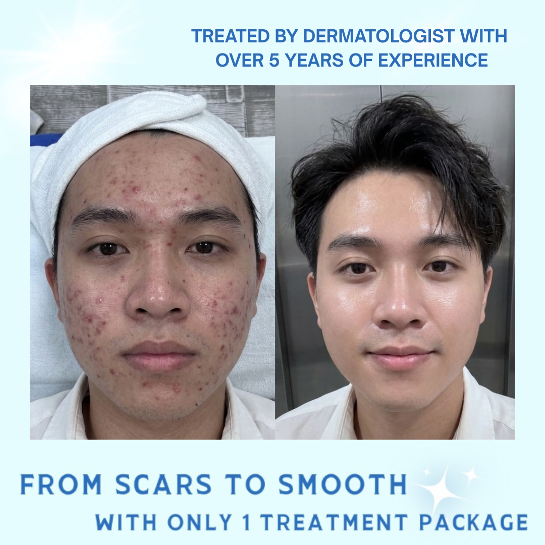 Mercy Acne & Skin Clinic in the Davao Facebook ad
