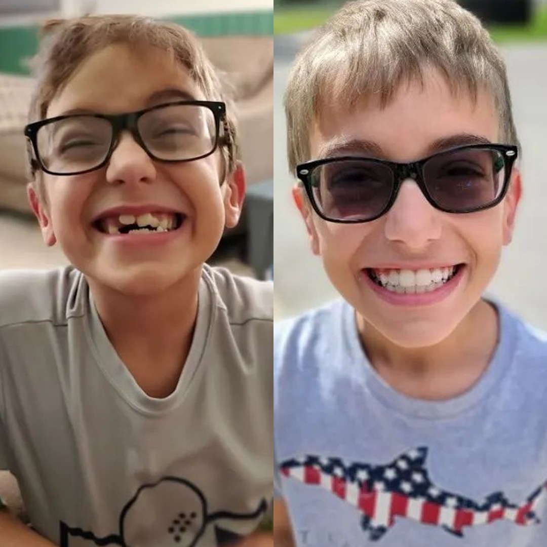 Invisalign Facebook ad
