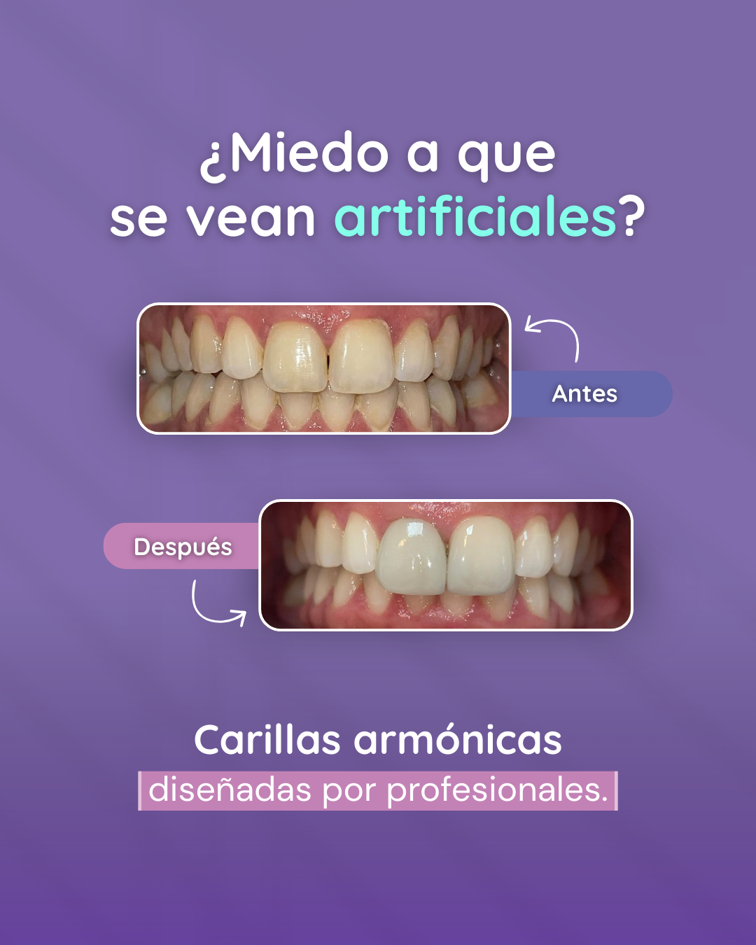 Glowup Argentina Facebook ad: Carillas - Glow Up Alineadores Transparentes