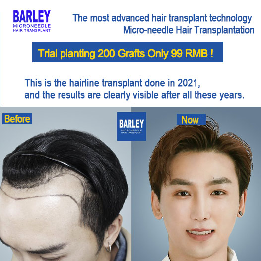 Barley Hair Transplant Facebook ad