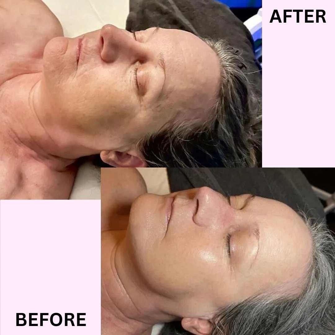 My Wellness Haven MedSpa Maryland Facebook ad: Non-surgical hydro lift NOW $299