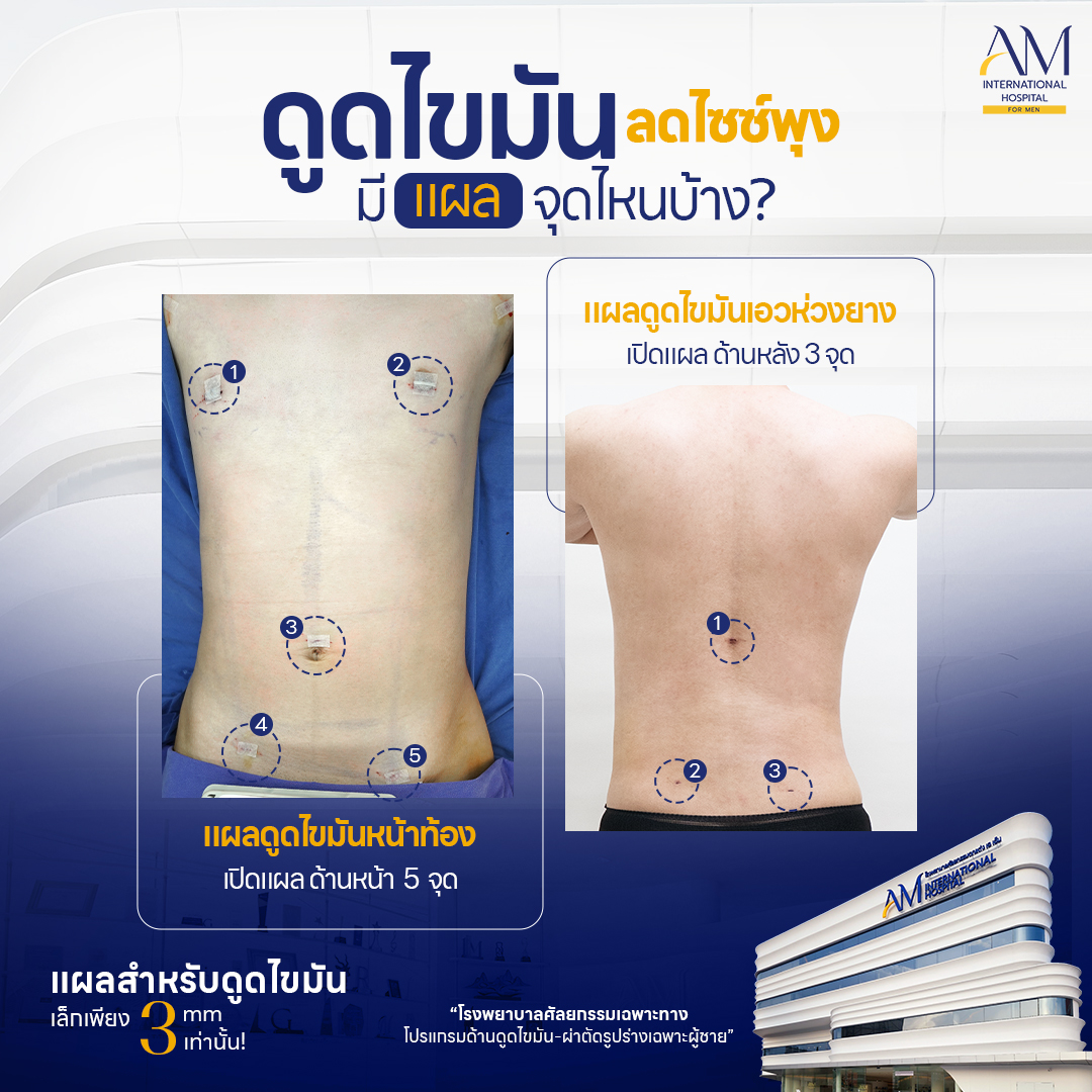 AMARA Liposuction for Men Facebook ad