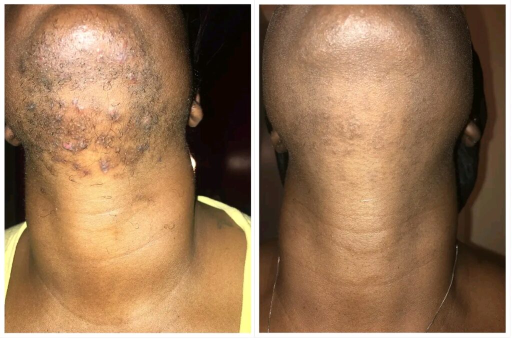 Get away pro Facebook ad: Stop worrying about razor bumps before every shave…