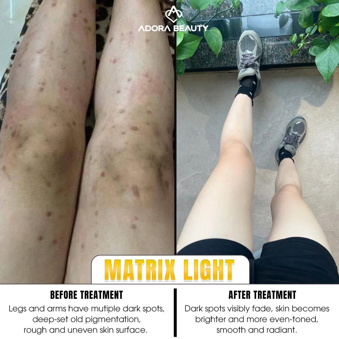 Adora Beauty Clinic - Dark Spot Solution Facebook ad: 30% OFF for only 10 spots left today! Free 1-on-1…