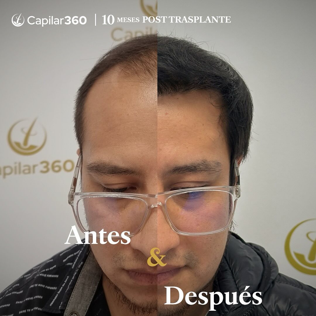 Capilar360 Facebook ad