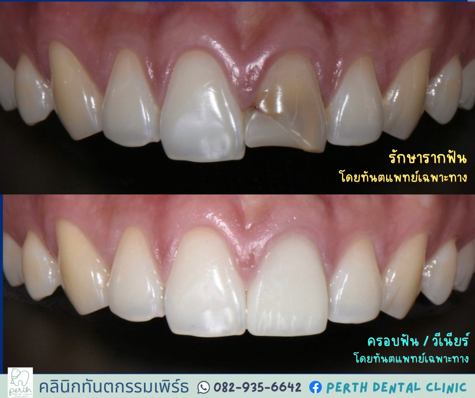 Perth Dental Clinic คลินิกทันตกรรมเพิร์ธ ทำฟัน จัดฟัน รักษารากฟัน แปลงยาว Facebook ad