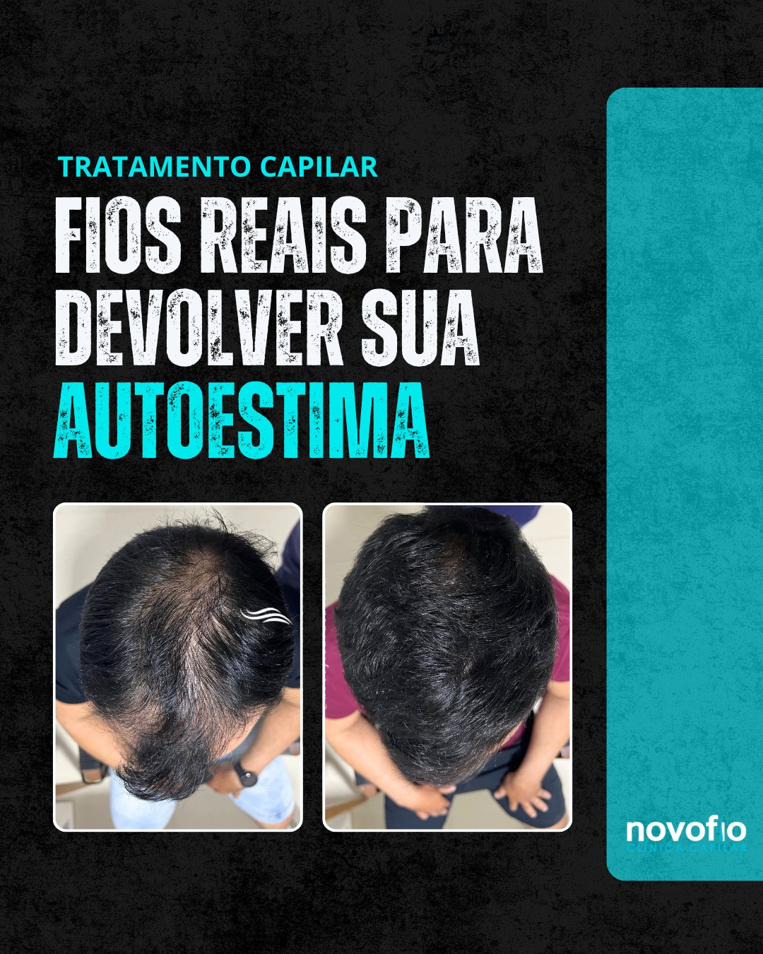 Novofio Araçatuba Clínica Capilar Facebook ad