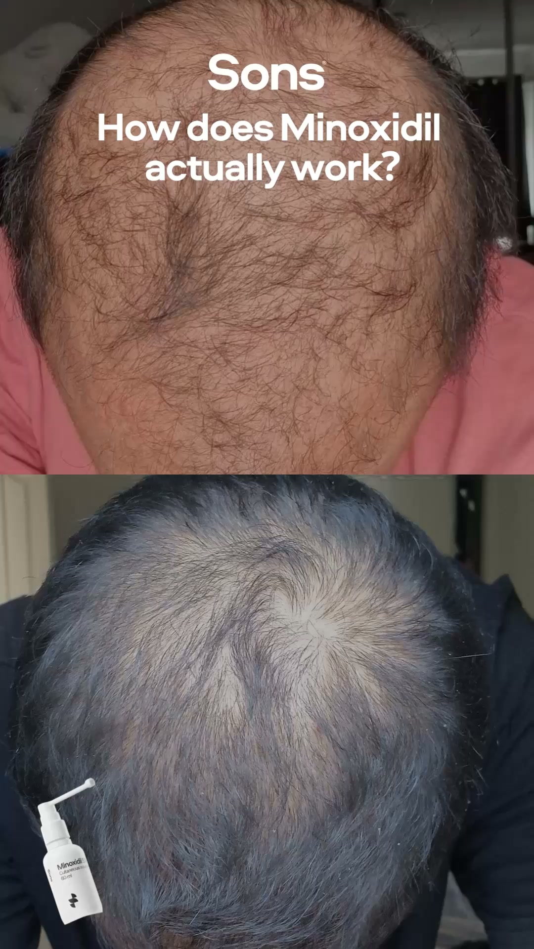 Sons Facebook ad: Your hairline. Your call.