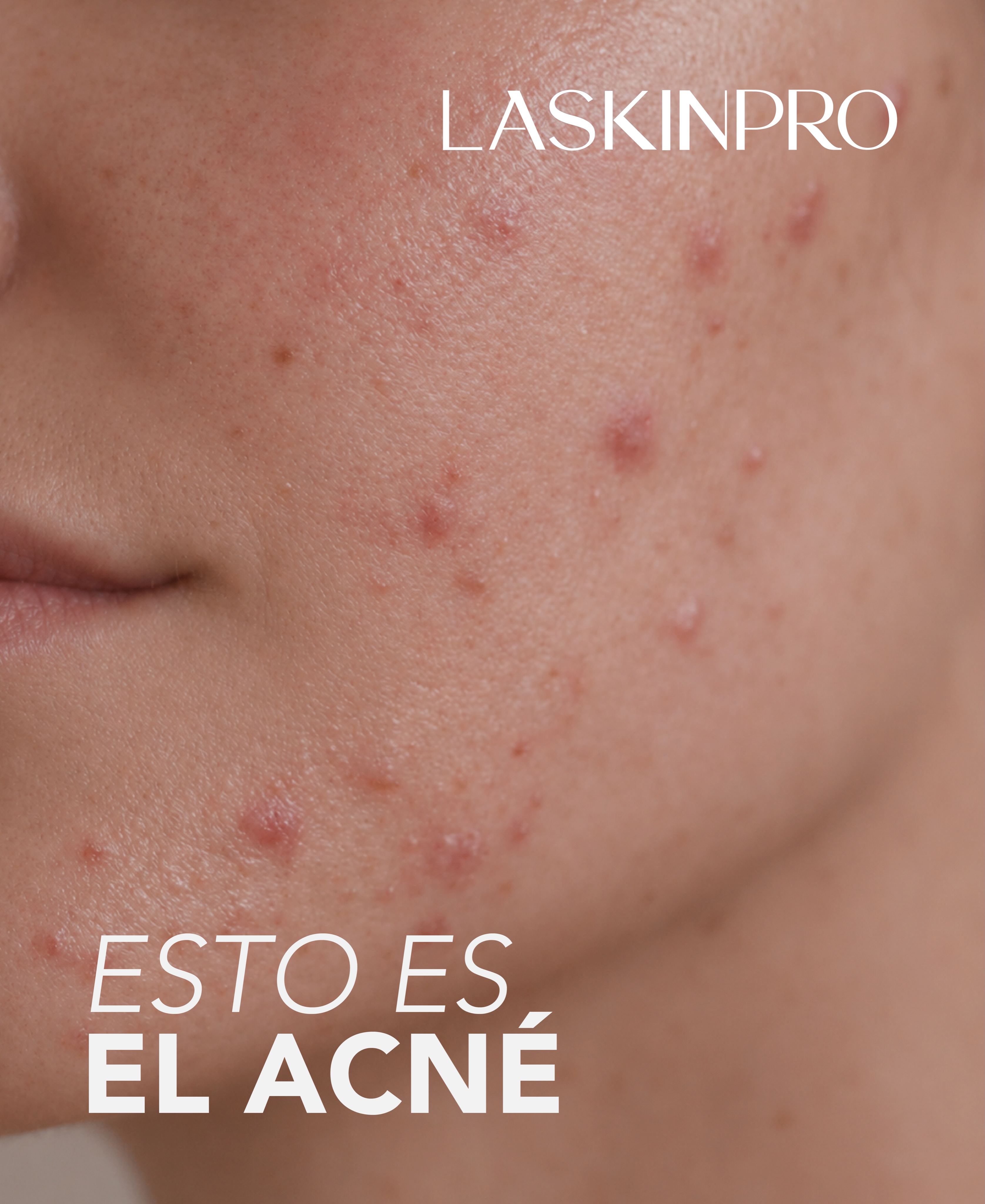 LASKIN - Expertos cuidando tu piel Facebook ad: El tratamiento del acné comienza con una valoración…