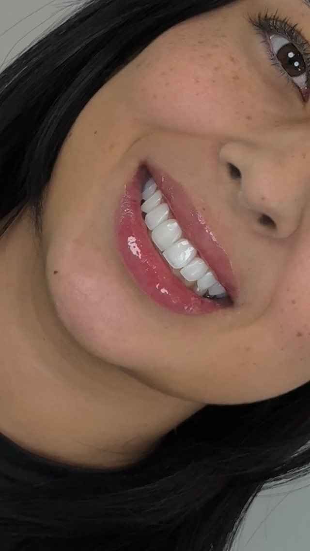 Dra Ana Clara Teodoro Facebook ad: O real brilho das lentes em resina está…