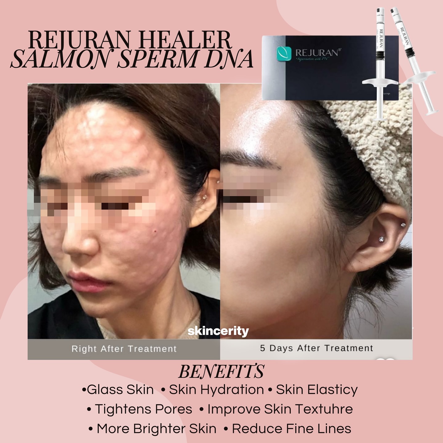 skincerityph Facebook ad: Rejuran is now in the Philippines