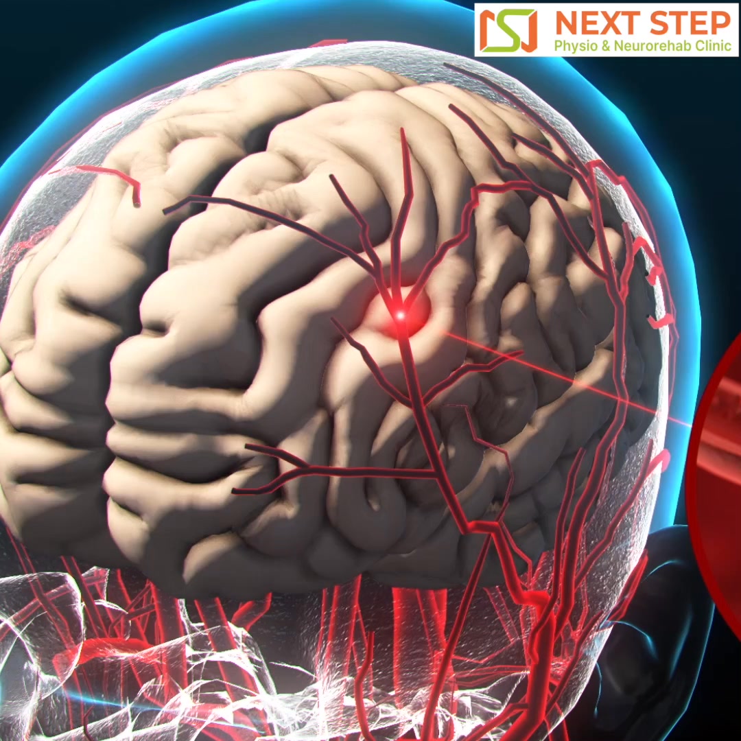 Next Step Physio & Neurorehab Facebook ad from Jun 29, 2026