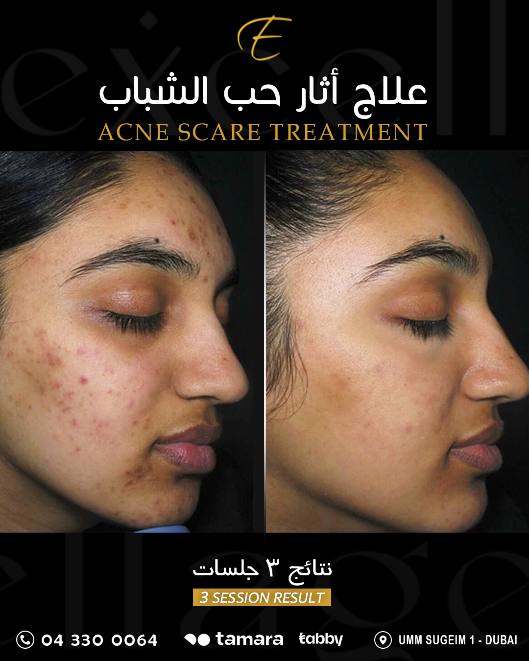 Excellage Clinic Facebook ad: آثار حبّ الشباب… بشرة أنعم وثقة أكبر