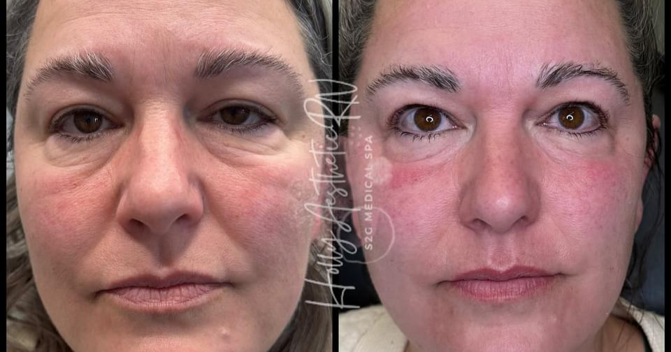 Holly Aesthetics RN Facebook ad: Fotona 4D Laser