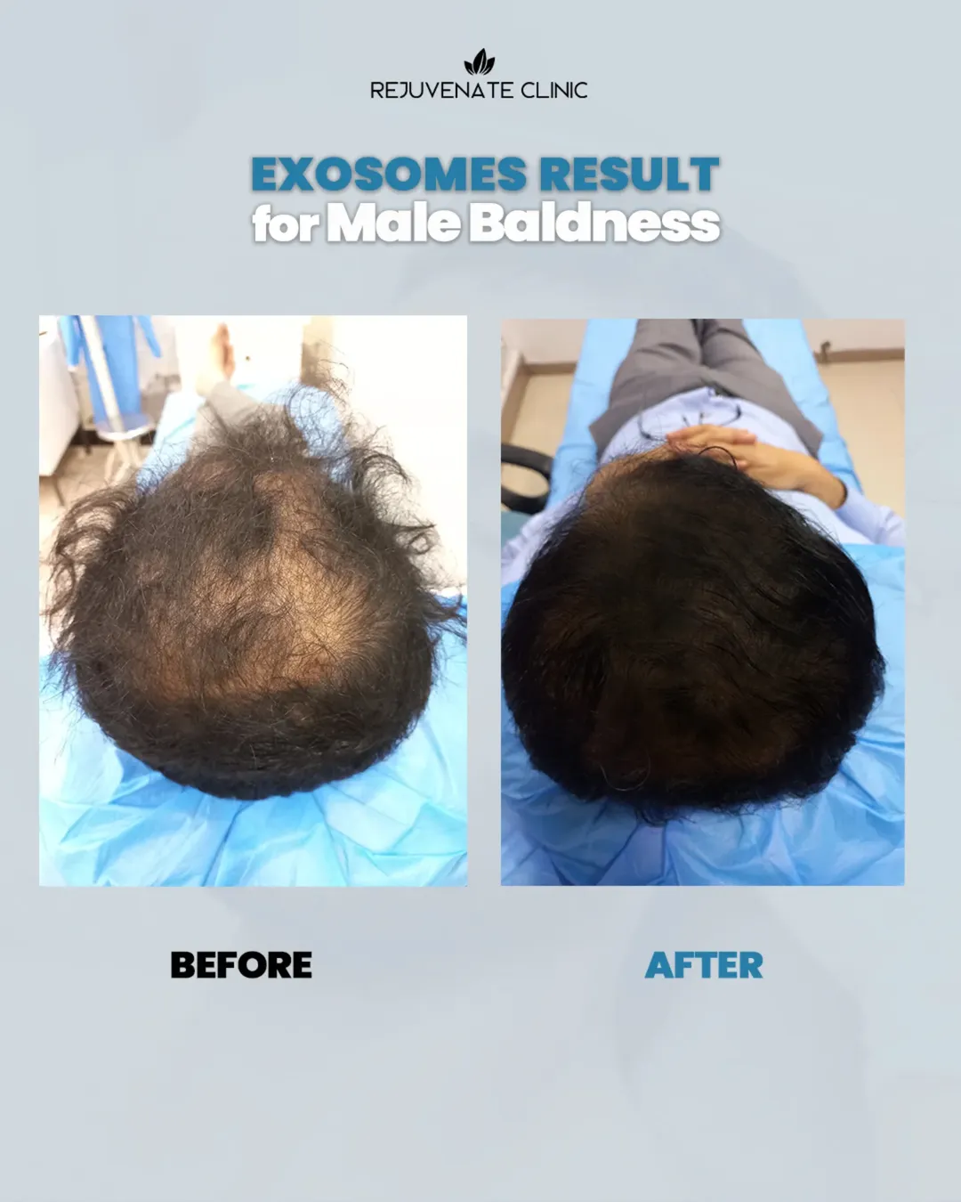 Rejuvenate Clinic Facebook ad: Hair fall is not just about using shampoos…