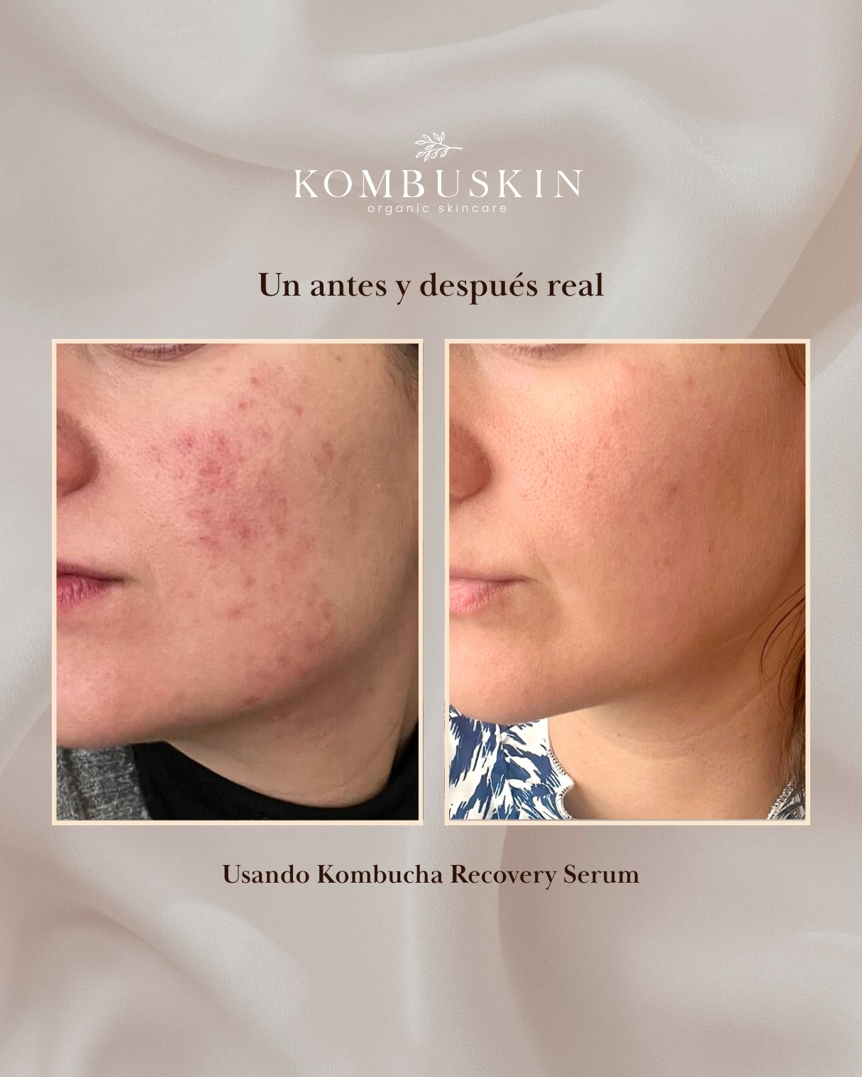 Kombuskin Facebook ad: Si tienes brotes, marcas de acné o sientes…