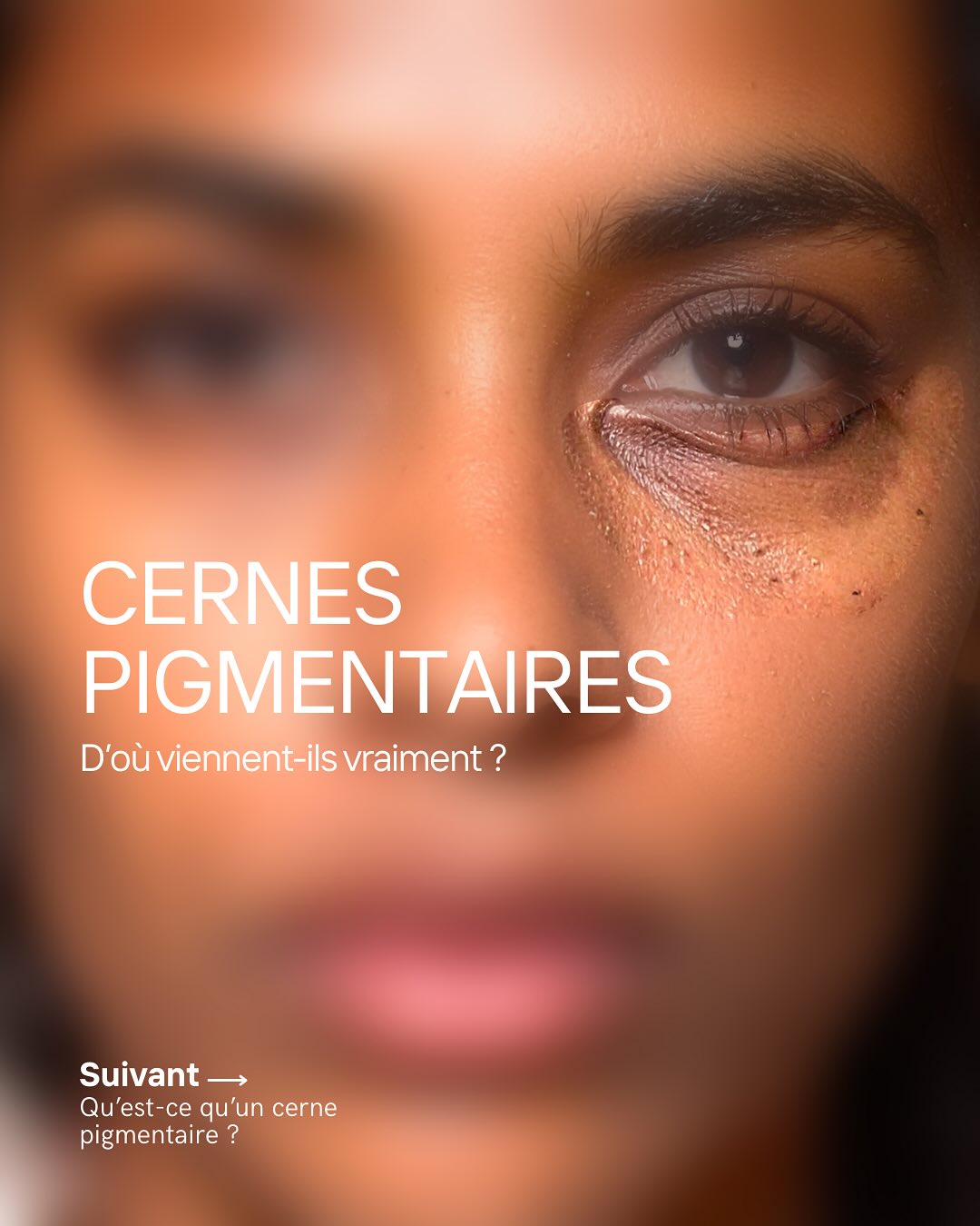 Institut De La Peau Nation Facebook ad: Les cernes pigmentaires ne sont pas qu’une simple…