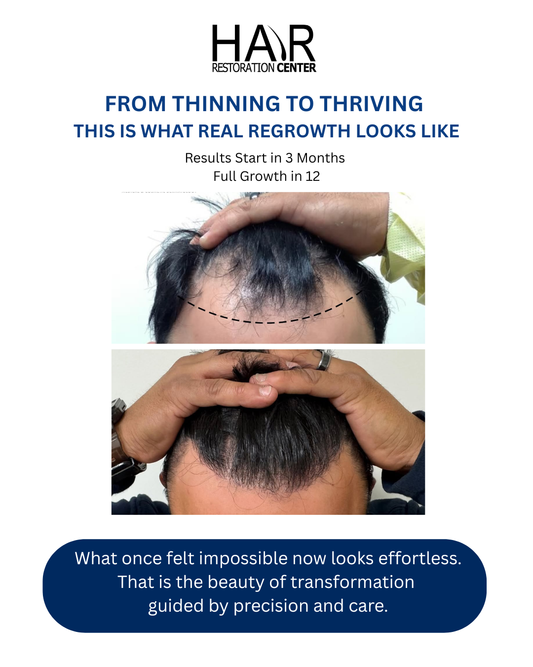 Hair Restoration Center Facebook ad: Hair Transplant Consultation