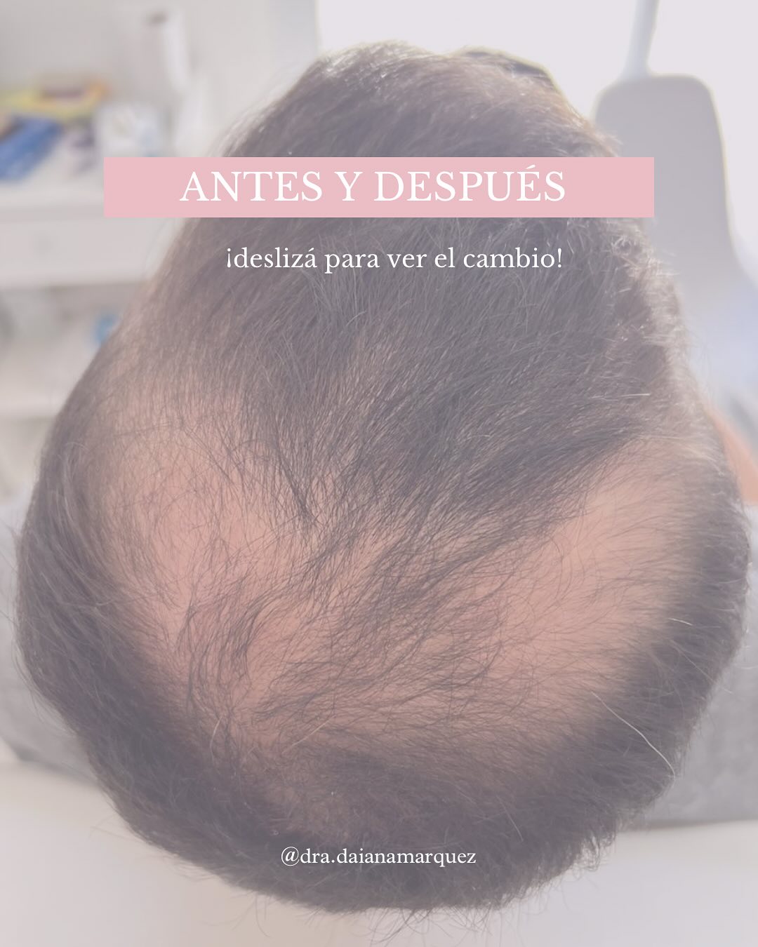 Indira Medicina Estética - Dra. Daiana Marquez Facebook ad: RECUPERACIÓN CAPILAR SIN CIRUGÍA