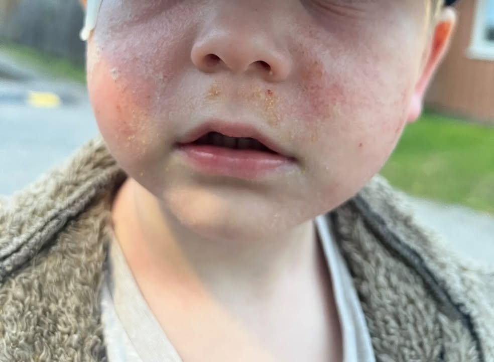 HUMLE från Kalvsved Facebook ad: 3-åriga Ragnar hade torr, känslig hud som blev…