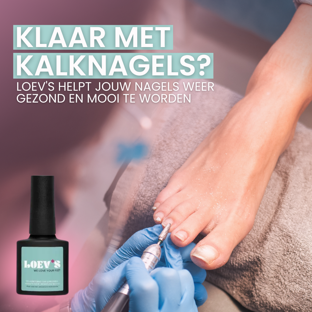 Loev's Facebook ad: Weg met die lelijke kalknagels!