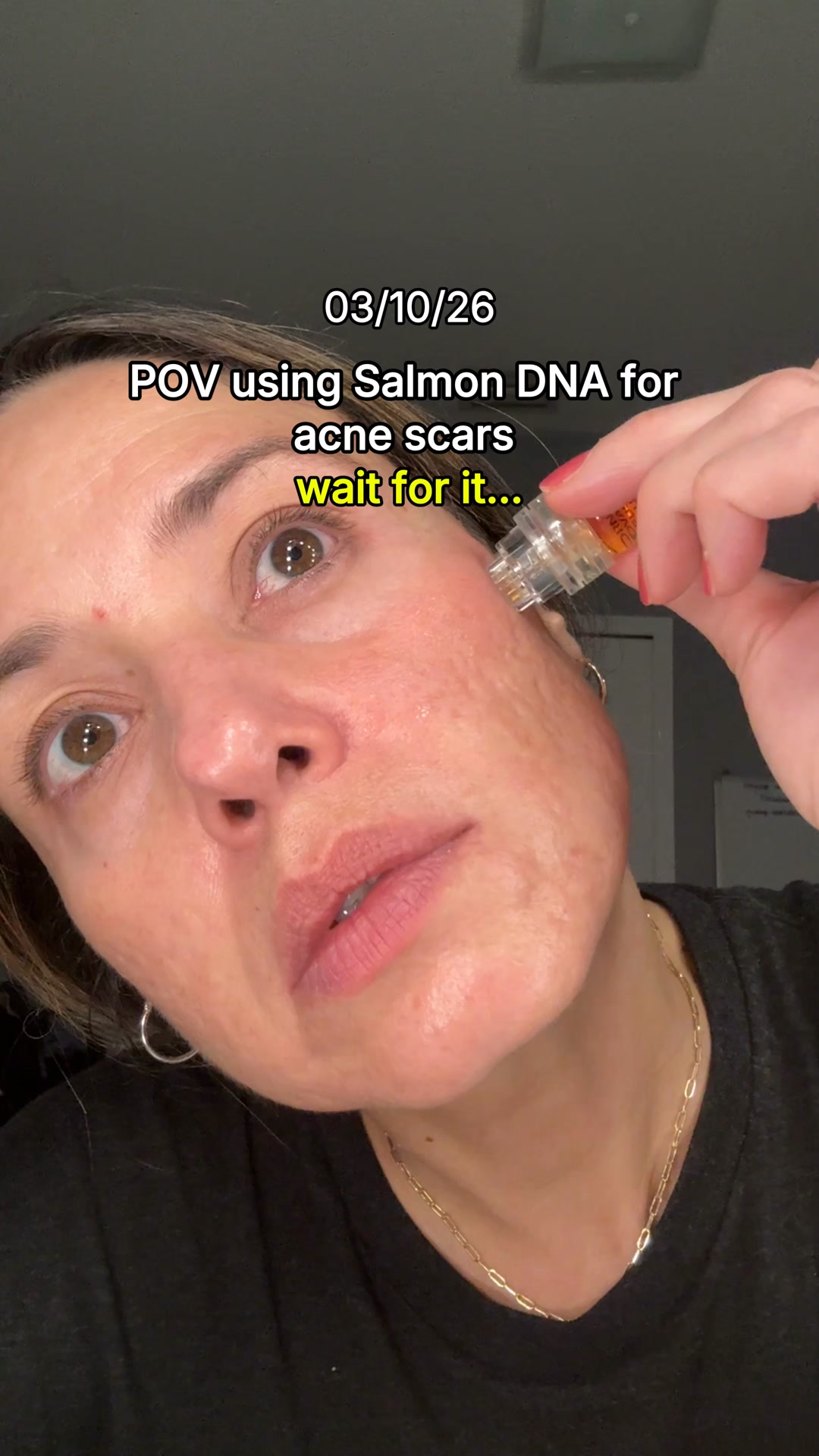 The DRM LAB Facebook ad: My Acne Scar Progress In 90 Days