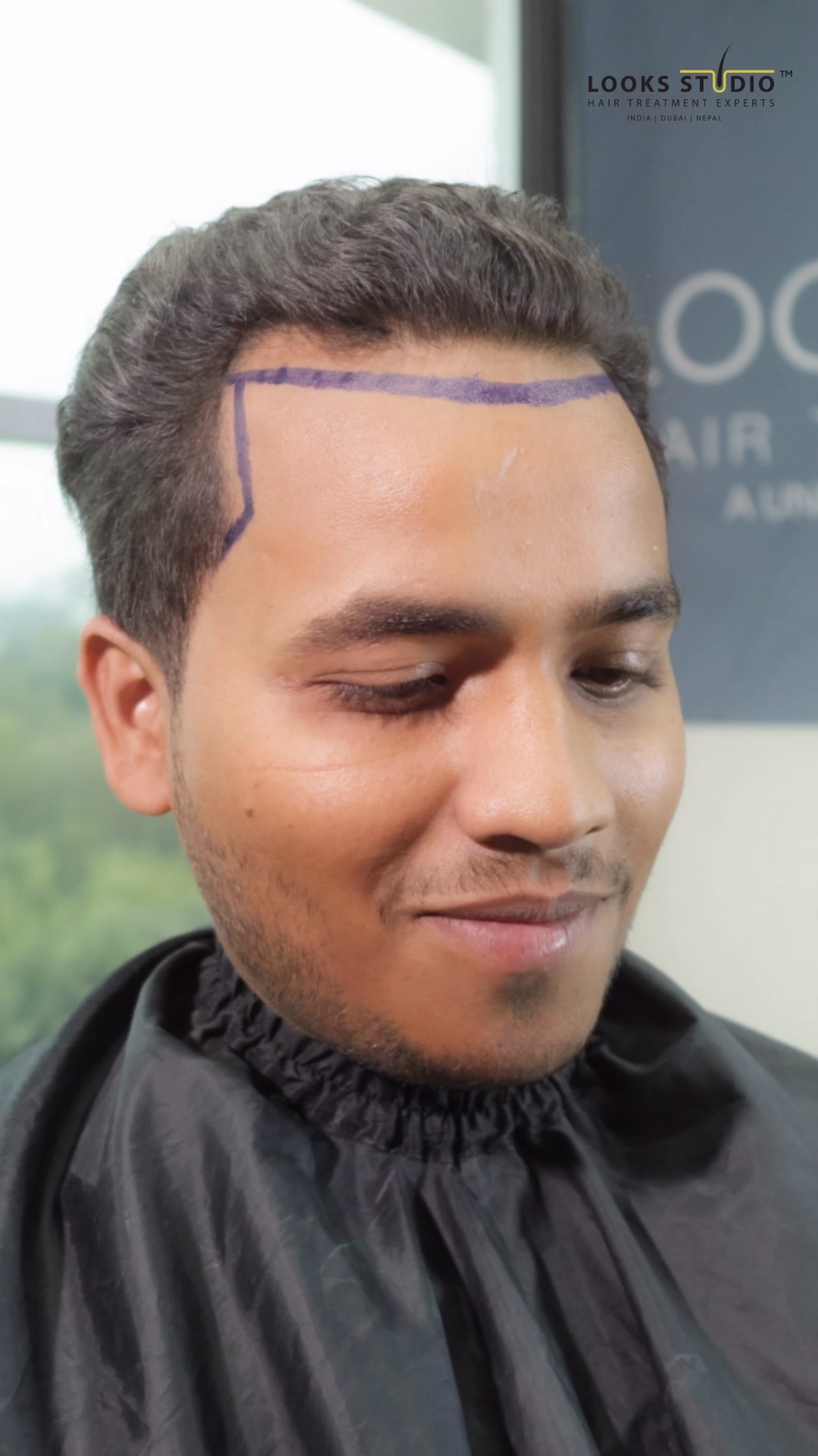 Looks Studio Hair Transplant Facebook ad: Bio-Integrated FUE advanced technique for natural results