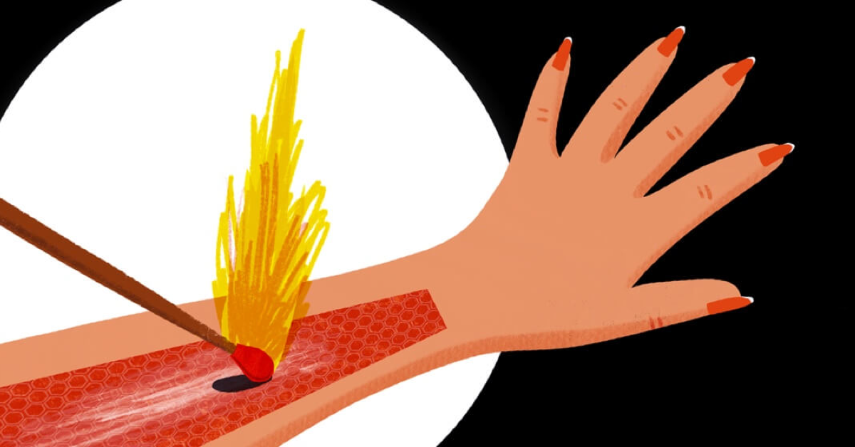 AtopicDermatitis.net Facebook ad: My 6 Common Eczema Triggers