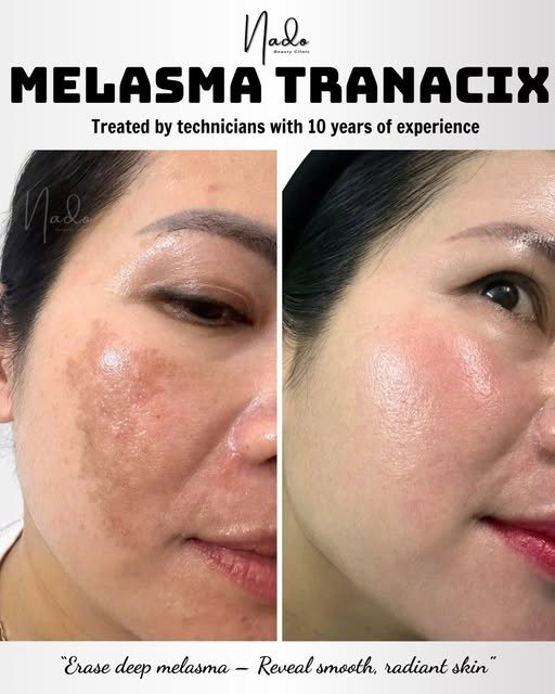 Nado Aesthetic Facebook ad: 99% MELASMA CLEARED WITH MELASMA TRANACIX, EVEN SKIN…