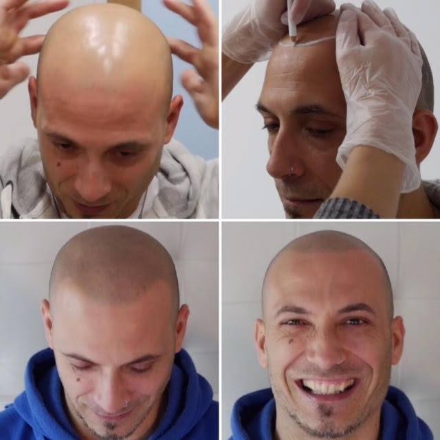 The Look SMP Melbourne, Scalp Micropigmentation Melbourne Facebook ad: SMP for bald men