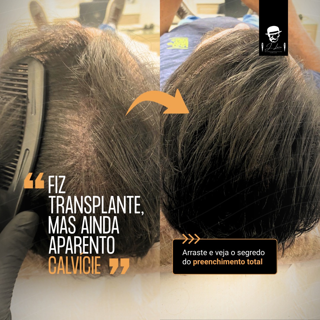 Jônatas Lara Especialista em Saúde Capilar Facebook ad: A micropigmentação capilar é a solução ideal para…