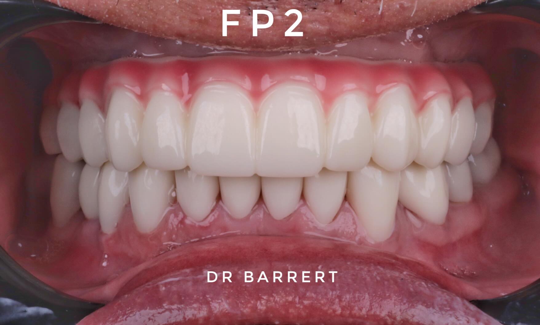 Dr. Albert Barrert Facebook ad: Definitive Full-Arch Implant Rehabilitation, All-on-5