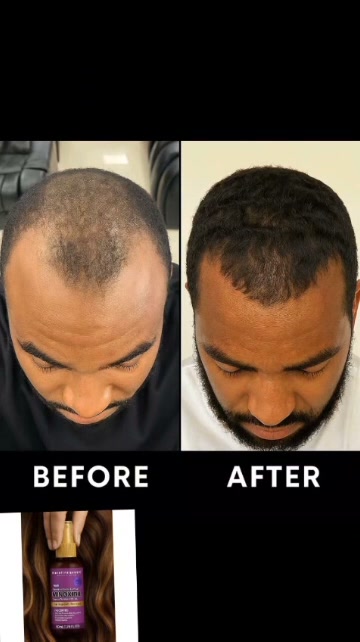 Life Tech Gadgets Zw Facebook ad: Minoxidil 5% and Dermaroller combo readily Available $20…
