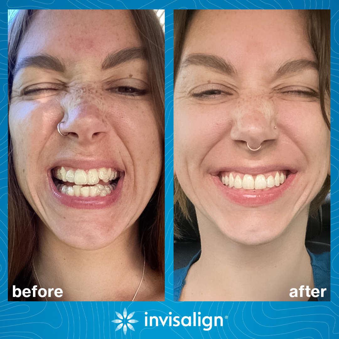 Invisalign Facebook ad