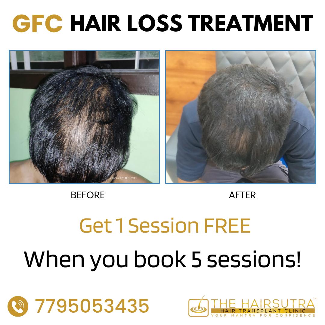 The Hairsutra Hair Transplant Clinic Facebook ad