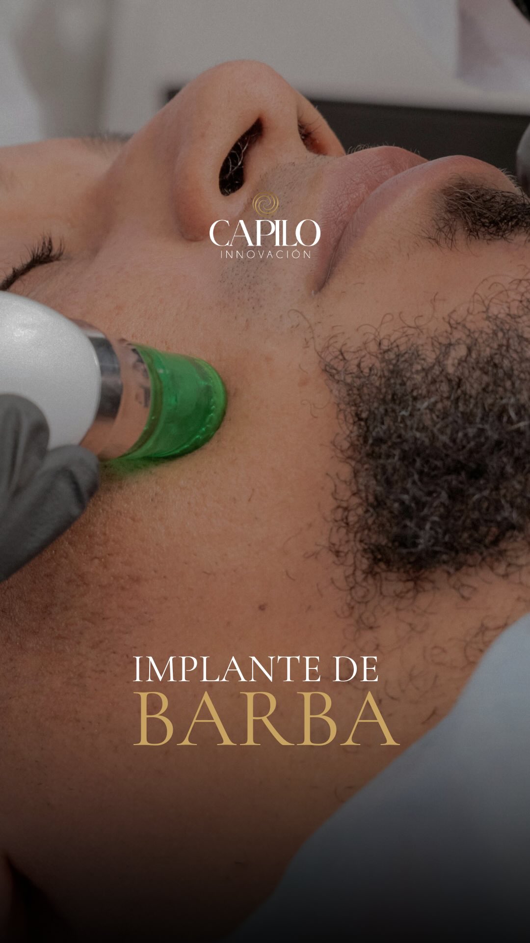 Capilo Innovación Facebook ad: Implante capilar de barba en Capilo