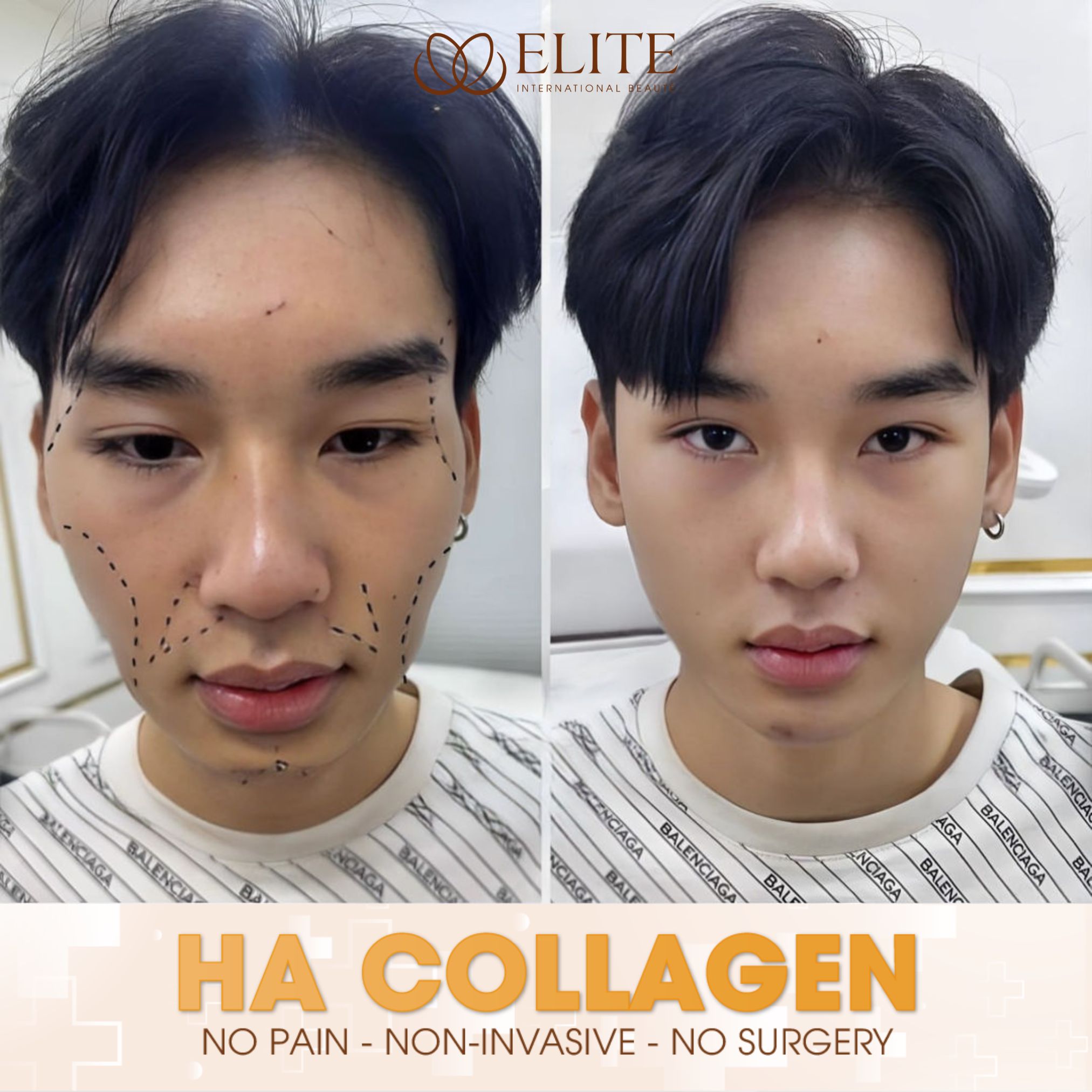 ELITE International Aesthetic Institute - Laguna Branch Facebook ad