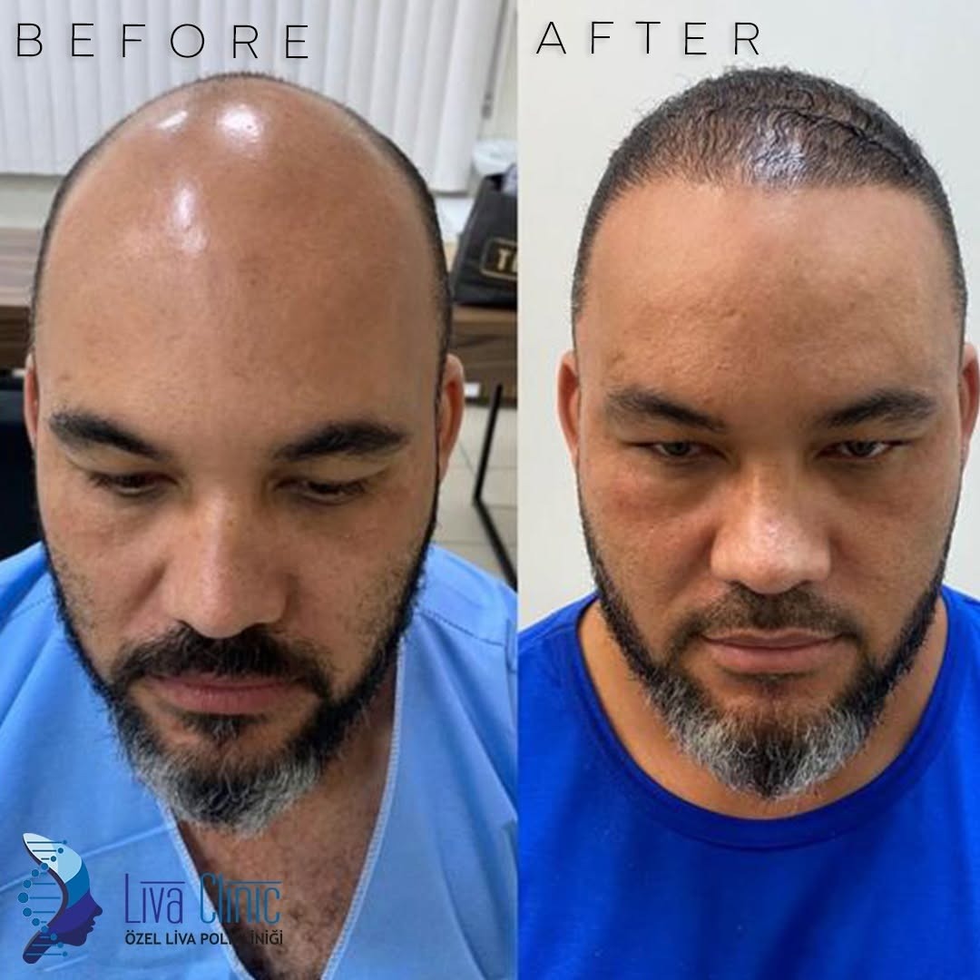 Liva Clinic Hair Transplant Facebook ad: Remplissez le formulaire pour obtenir une consultation…